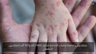 بنجلاديش: حصيلة وفيات الحصبة تتجاوز 1000 حالة و187 ألف إصابة بين الأطفال