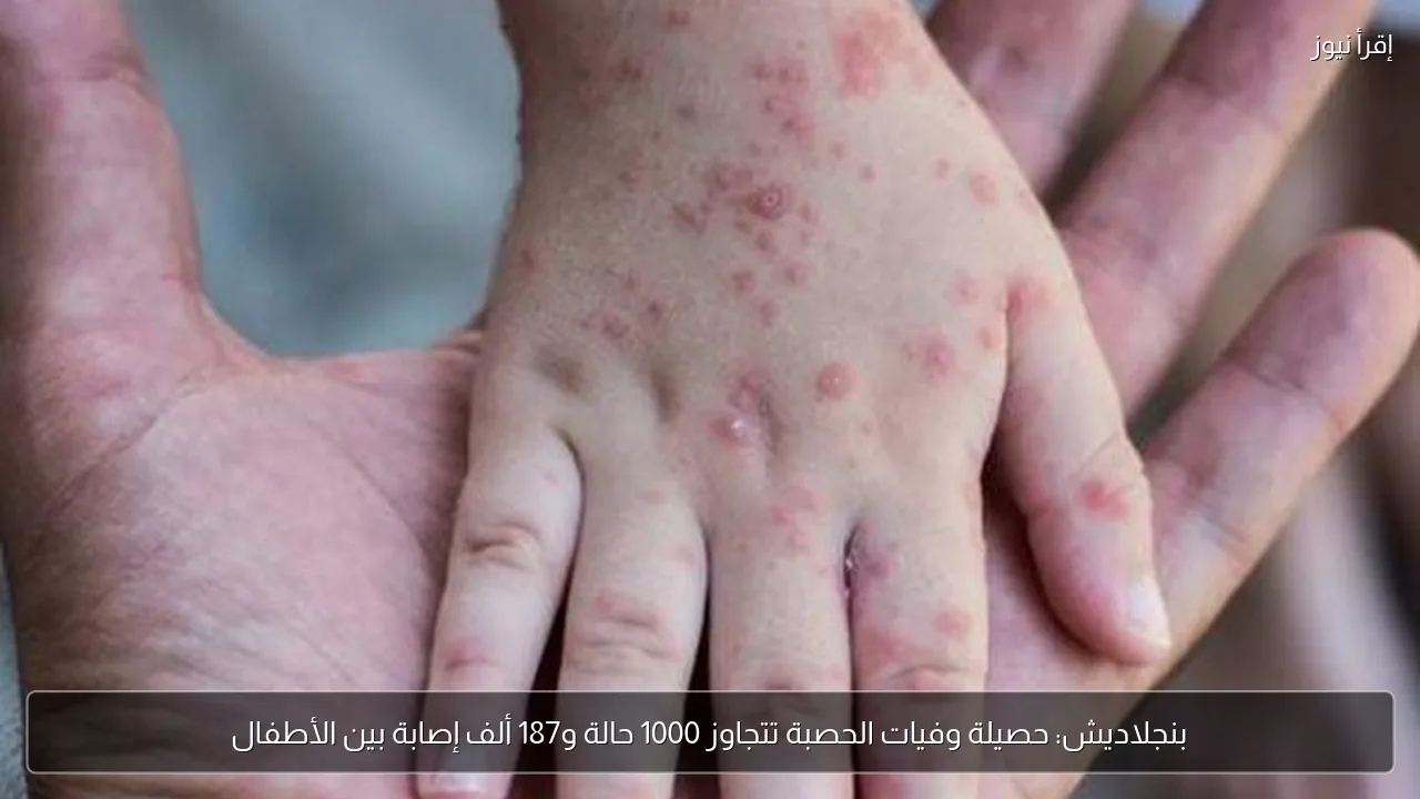 بنجلاديش: حصيلة وفيات الحصبة تتجاوز 1000 حالة و187 ألف إصابة بين الأطفال
