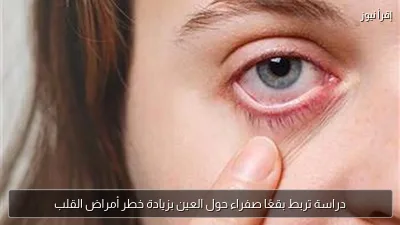 دراسة تربط بقعًا صفراء حول العين بزيادة خطر أمراض القلب