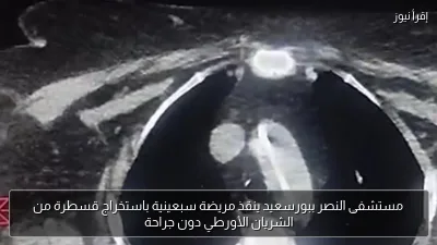 مستشفى النصر ببورسعيد ينقذ مريضة سبعينية باستخراج قسطرة من الشريان الأورطي دون جراحة