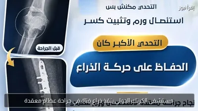 مستشفى الكرنك الدولي ينقذ ذراع فتاة في جراحة عظام معقدة
