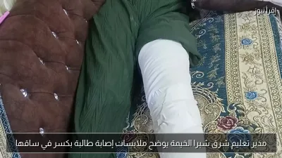 مدير تعليم شرق شبرا الخيمة يوضح ملابسات إصابة طالبة بكسر في ساقها