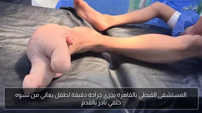 المستشفى القبطي بالقاهرة يجري جراحة دقيقة لطفل يعاني من تشوه خلقي نادر بالقدم