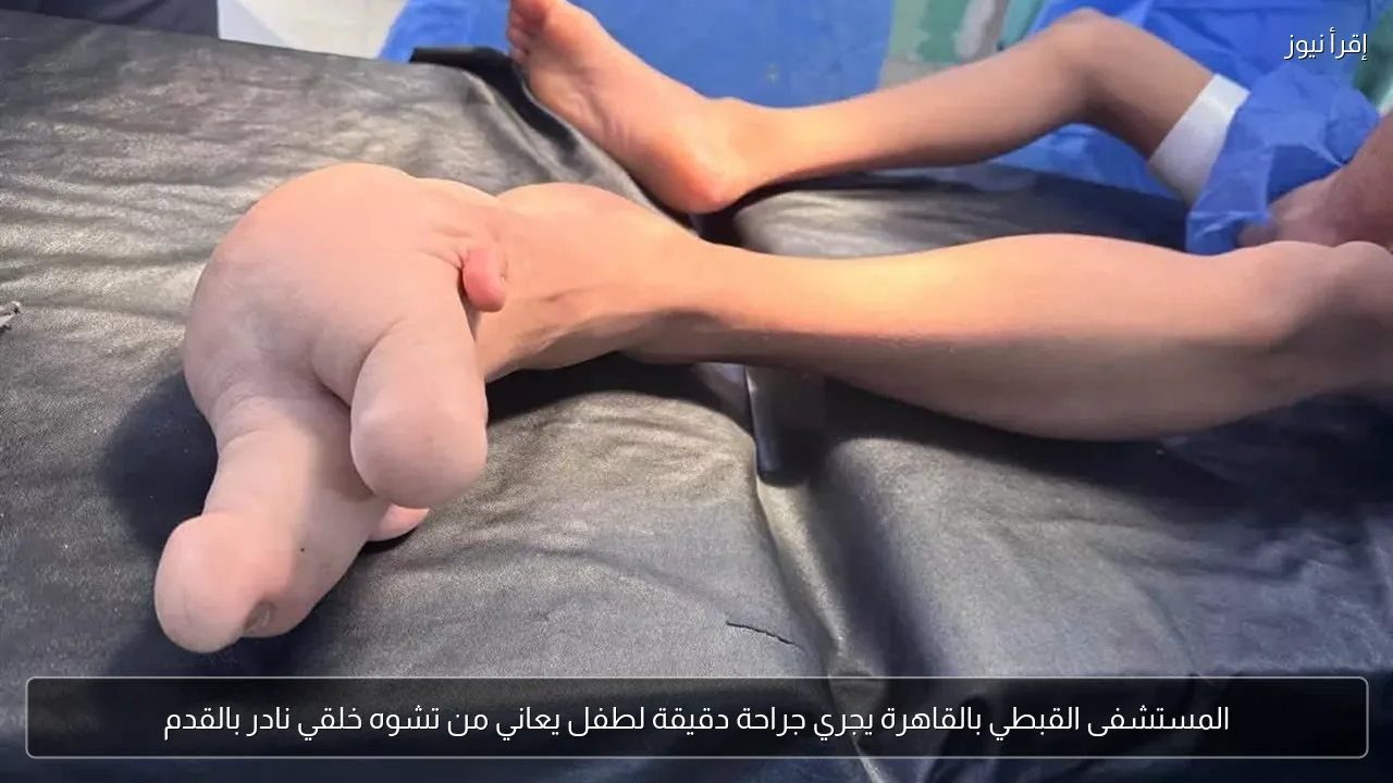 المستشفى القبطي بالقاهرة يجري جراحة دقيقة لطفل يعاني من تشوه خلقي نادر بالقدم
