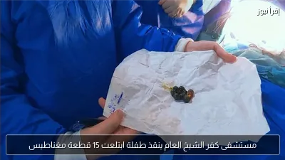 مستشفى كفر الشيخ العام ينقذ طفلة ابتلعت 15 قطعة مغناطيس