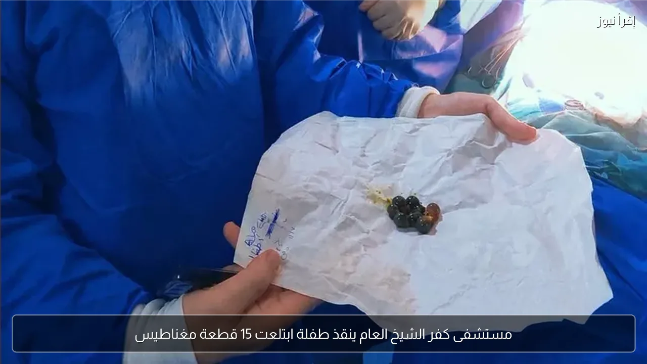 مستشفى كفر الشيخ العام ينقذ طفلة ابتلعت 15 قطعة مغناطيس