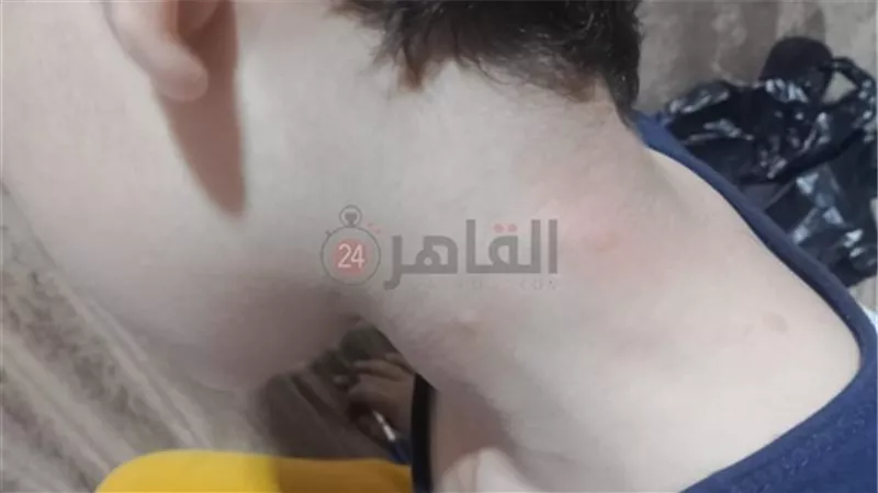 إصابة طالب بعد لدغة
