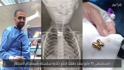 مستشفى 15 مايو ينقذ طفلًا ابتلع دلاية سلسلة باستخدام المنظار