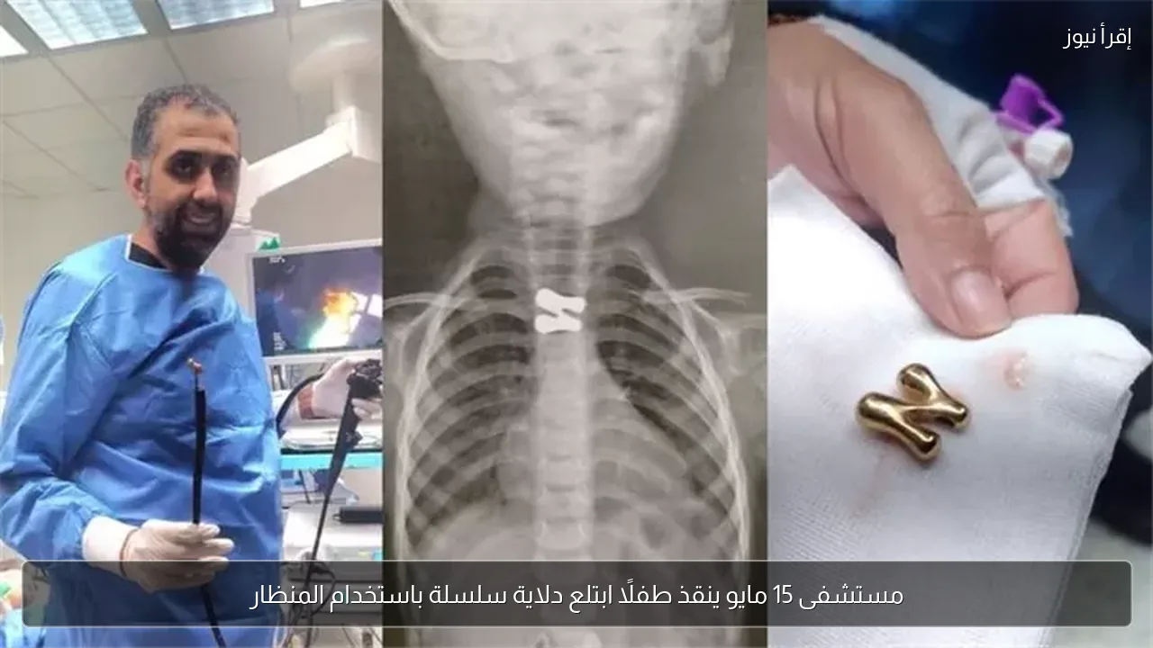 مستشفى 15 مايو ينقذ طفلًا ابتلع دلاية سلسلة باستخدام المنظار