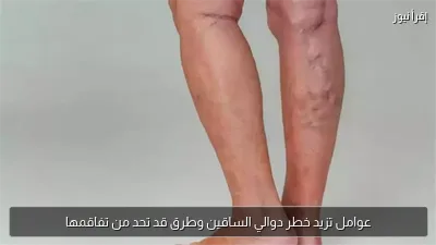 عوامل تزيد خطر دوالي الساقين وطرق قد تحد من تفاقمها