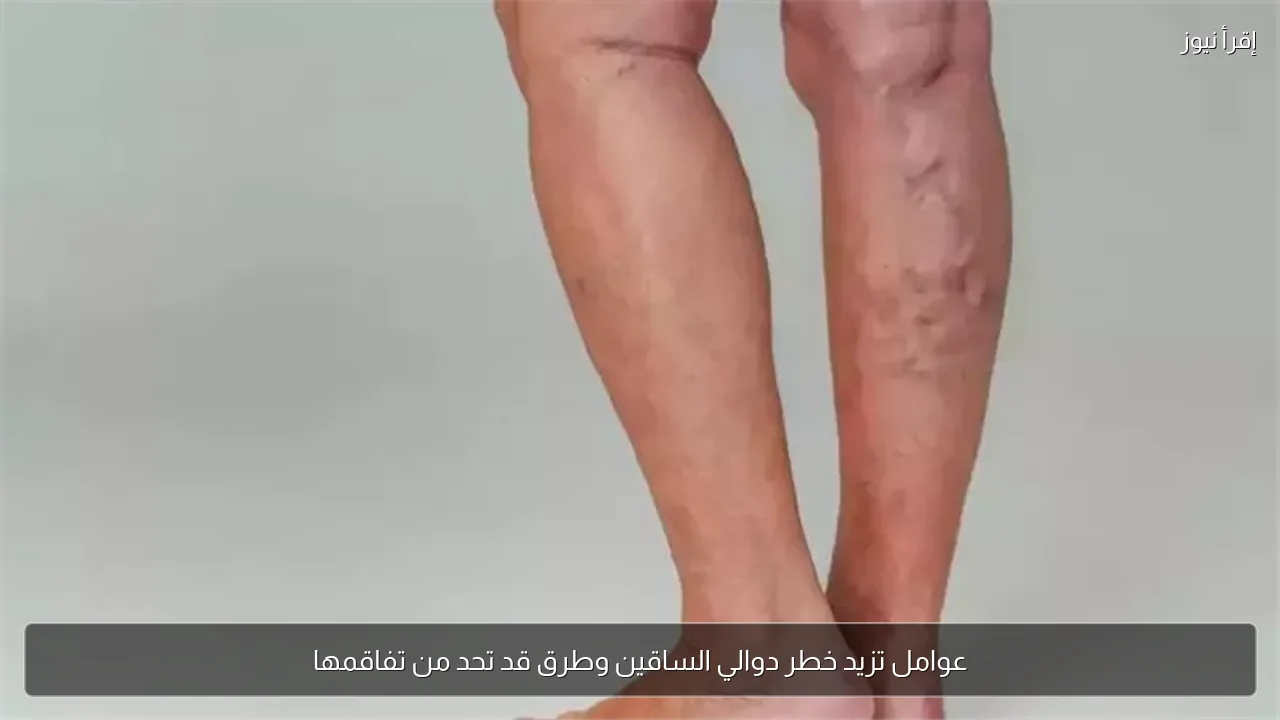 عوامل تزيد خطر دوالي الساقين وطرق قد تحد من تفاقمها