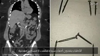 الأطباء ينقذون أمعاء سيدة ابتلعت 8 مسامير معدنية