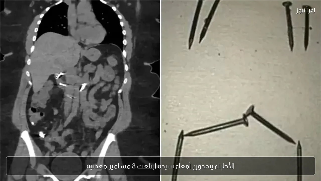 الأطباء ينقذون أمعاء سيدة ابتلعت 8 مسامير معدنية