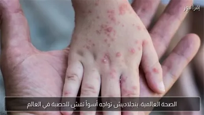 الصحة العالمية: بنجلاديش تواجه أسوأ تفشٍ للحصبة في العالم