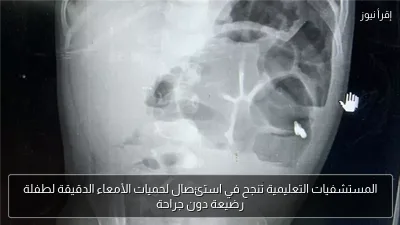 المستشفيات التعليمية تنجح في استئصال لحميات الأمعاء الدقيقة لطفلة رضيعة دون جراحة
