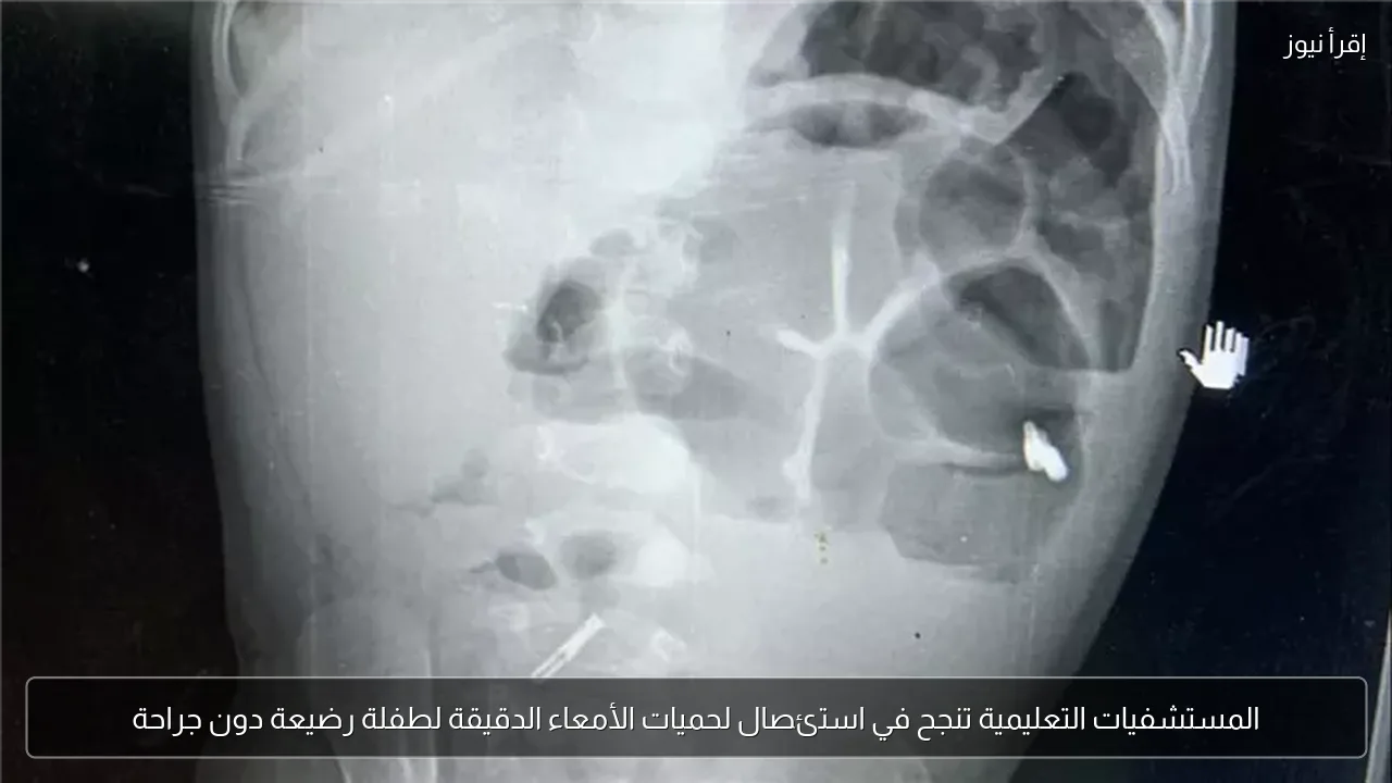 المستشفيات التعليمية تنجح في استئصال لحميات الأمعاء الدقيقة لطفلة رضيعة دون جراحة