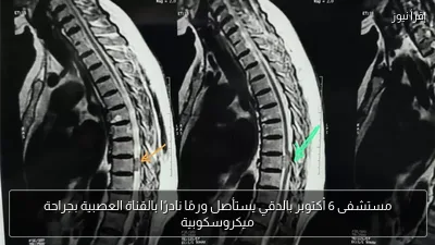 مستشفى 6 أكتوبر بالدقي يستأصل ورمًا نادرًا بالقناة العصبية بجراحة ميكروسكوبية