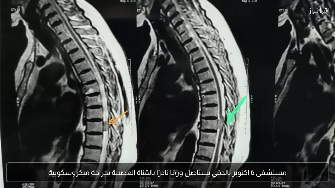 مستشفى 6 أكتوبر بالدقي يستأصل ورمًا نادرًا بالقناة العصبية بجراحة ميكروسكوبية