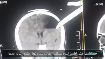 مستشفى كفر الشيخ العام يستقبل طالبة بعد دخول مقص في رأسها