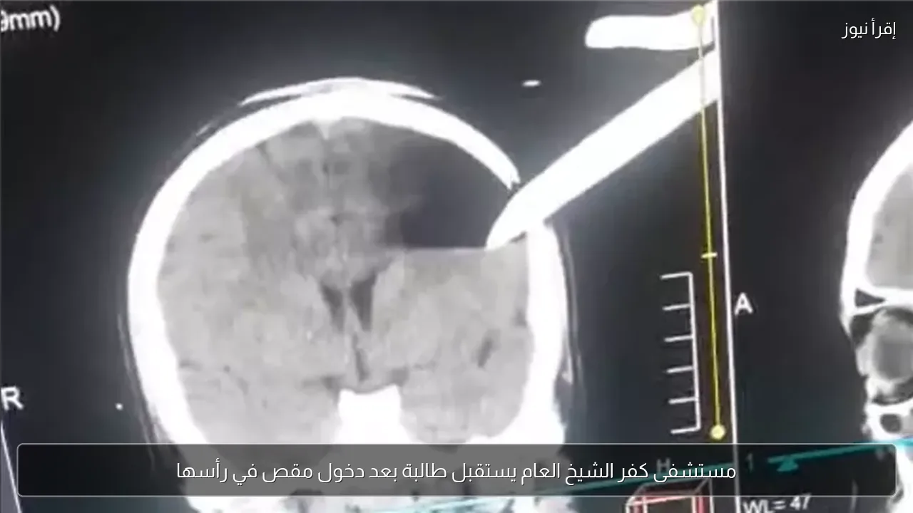 مستشفى كفر الشيخ العام يستقبل طالبة بعد دخول مقص في رأسها