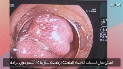 استئصال لحميات الأمعاء الدقيقة لرضيعة عمرها 10 أشهر دون جراحة