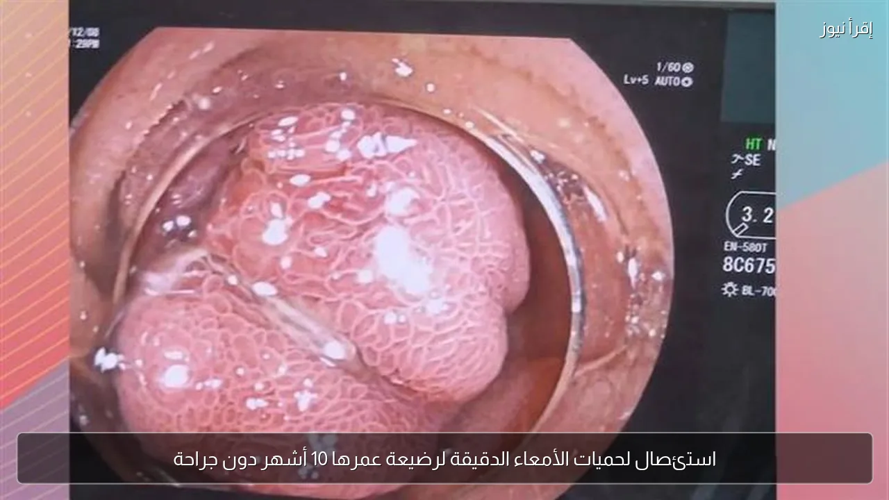 استئصال لحميات الأمعاء الدقيقة لرضيعة عمرها 10 أشهر دون جراحة