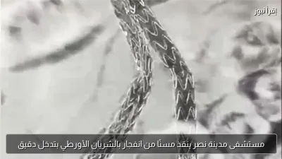 مستشفى مدينة نصر ينقذ مسنًا من انفجار بالشريان الأورطي بتدخل دقيق