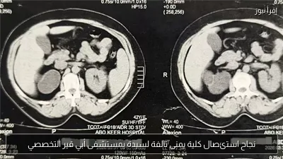 نجاح استئصال كلية يمنى تالفة لسيدة بمستشفى أبي قير التخصصي