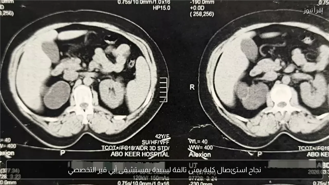نجاح استئصال كلية يمنى تالفة لسيدة بمستشفى أبي قير التخصصي
