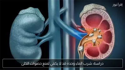 دراسة: شرب الماء وحده قد لا يكفي لمنع حصوات الكلى