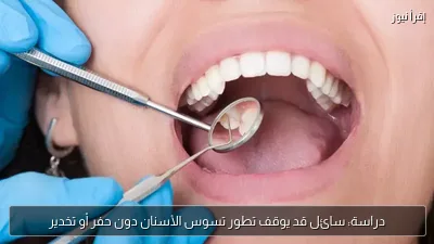 دراسة: سائل قد يوقف تطور تسوس الأسنان دون حفر أو تخدير