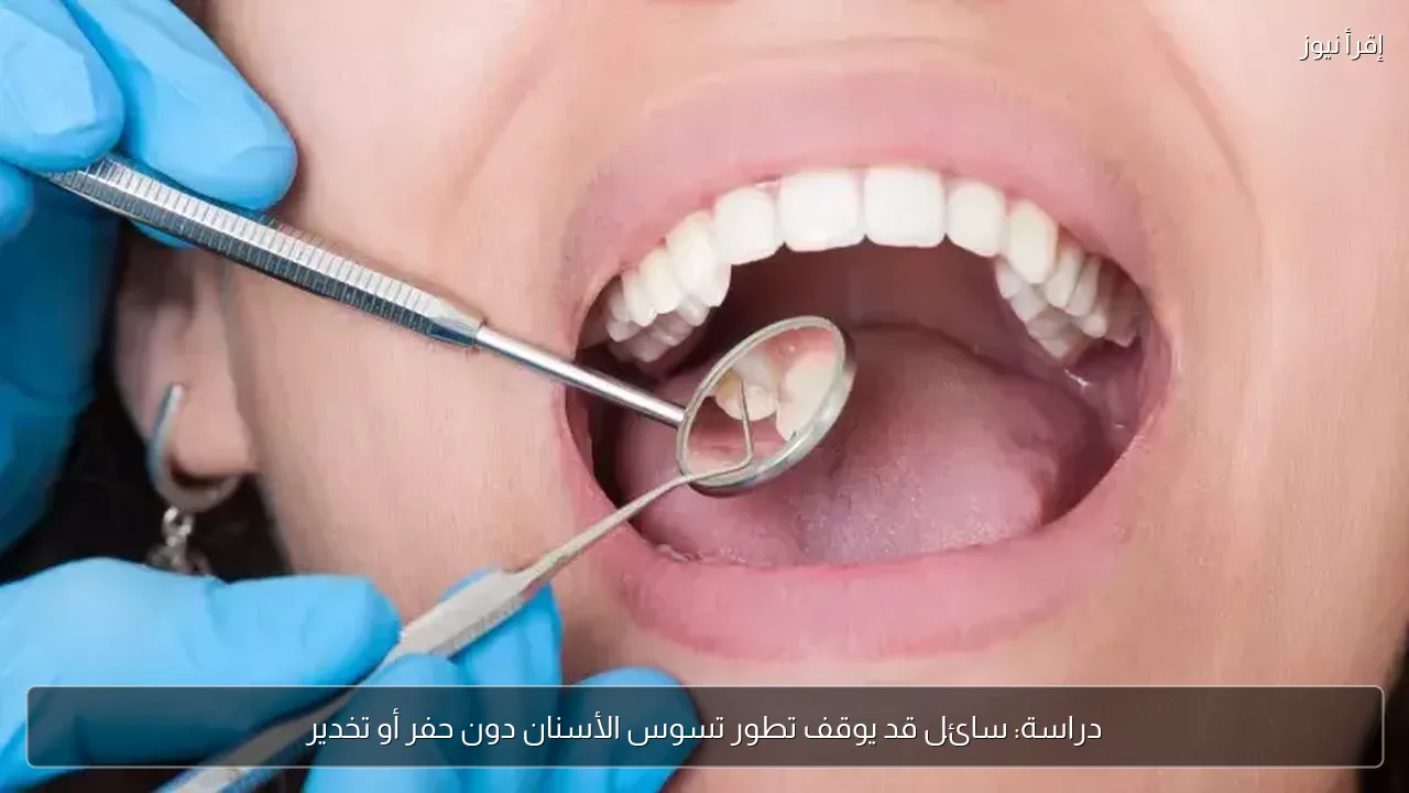 دراسة: سائل قد يوقف تطور تسوس الأسنان دون حفر أو تخدير