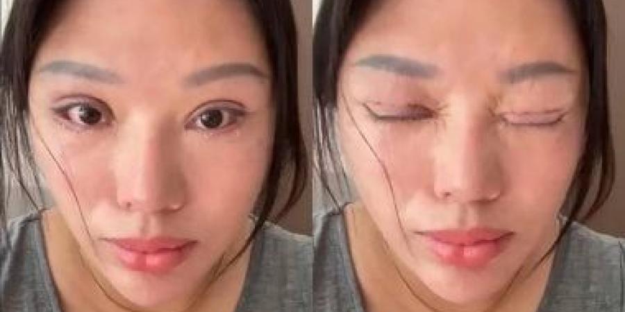 صينية تعجز عن إغلاق عينيها بعد جراحة تجميل فاشلة وتلزم بدفع تعويض للطبيب