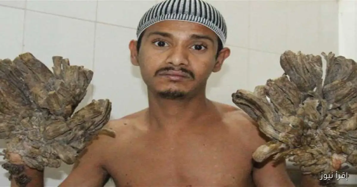 أعراض ومضاعفات متلازمة الرجل الشجرة: حالة طبية خطيرة قد تتحول إلى ورم خبيث دون علاج