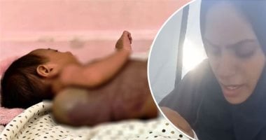 رضيعة في غزة تواجه أزمة صحية خطيرة بسبب كيس دموي وسط نقص الرعاية الطبية