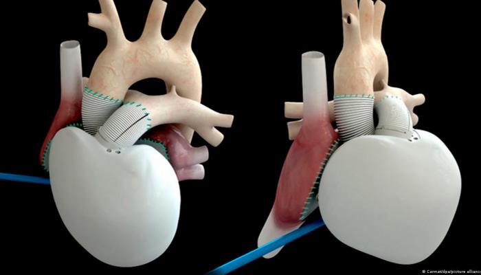 نهاية مثيرة لصراع طويل.. القلب الاصطناعي الفرنسي ينعش من جديد